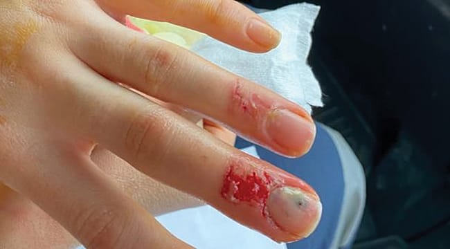 Samsun’da bir hasta ambulans görevlisi sağlıkçı kadının parmaklarını ısırdı